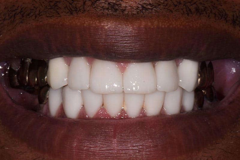 Patient Smile Before & After Gallery - Patient 224320 - Image 4