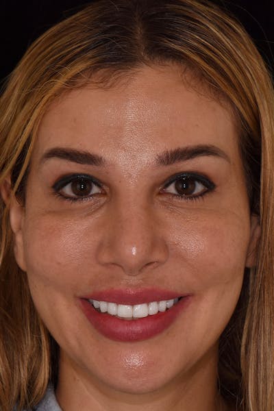 Patient Smile Before & After Gallery - Patient 175633 - Image 2