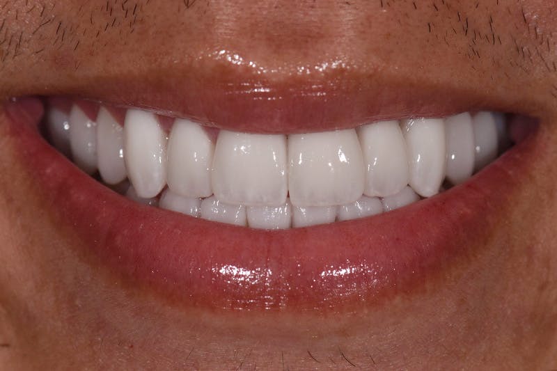 Patient Smile Before & After Gallery - Patient 990180 - Image 4