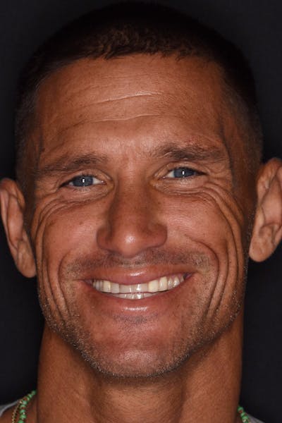 Patient Smile Before & After Gallery - Patient 248930 - Image 1