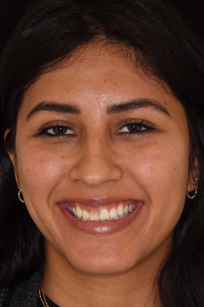 Patient Smile Before & After Gallery - Patient 259936 - Image 1