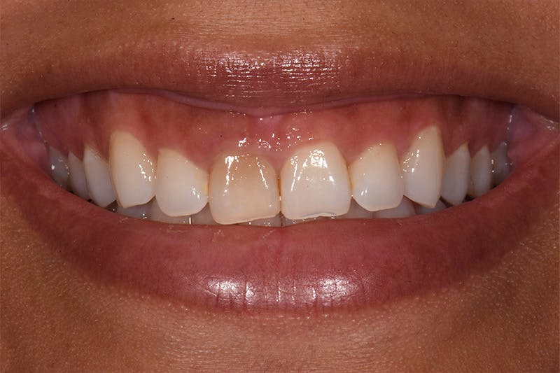 Patient Smile Before & After Gallery - Patient 259936 - Image 3