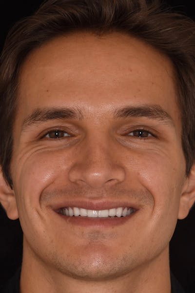 Patient Smile Before & After Gallery - Patient 183733 - Image 2