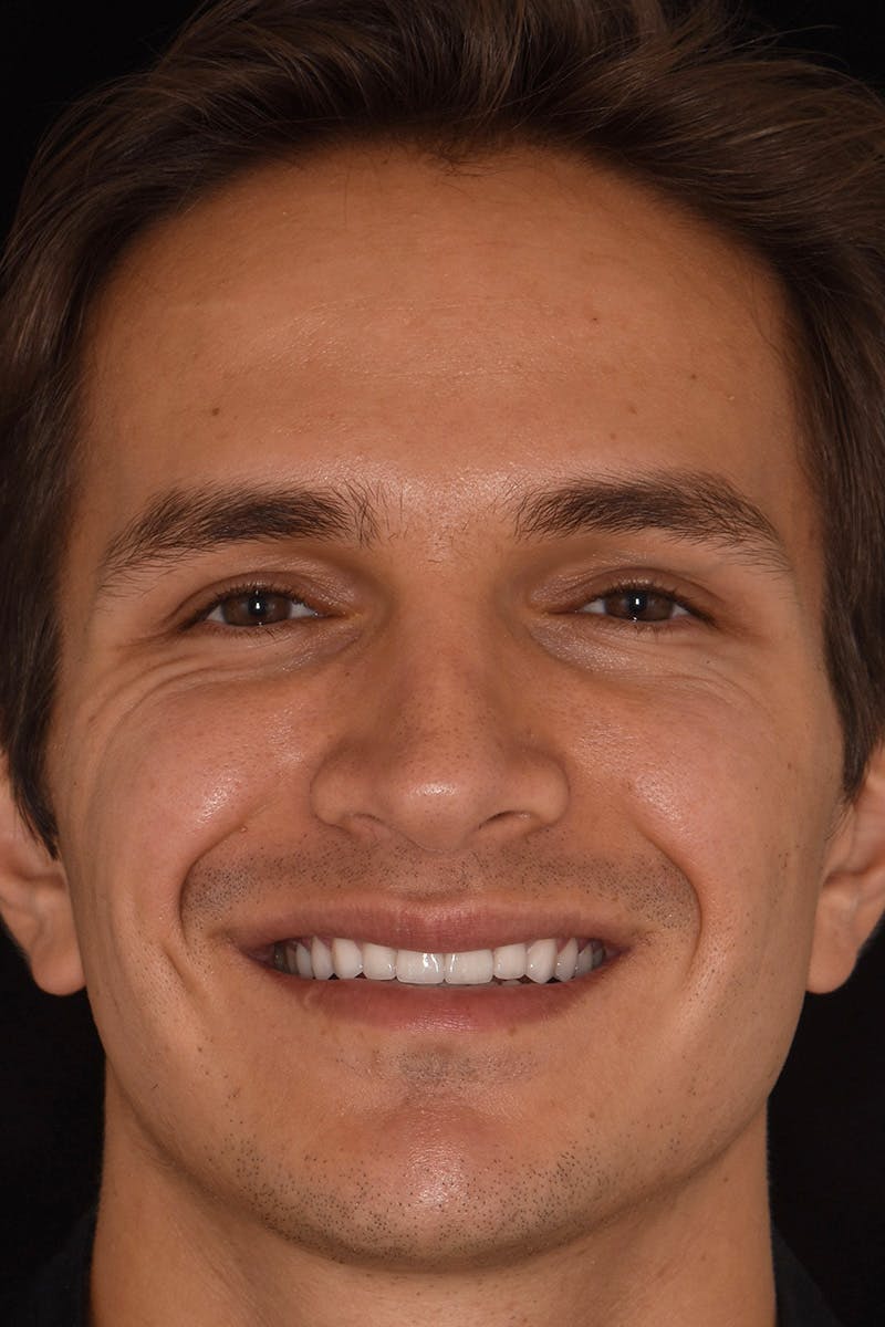 Patient Smile Before & After Gallery - Patient 183733 - Image 2