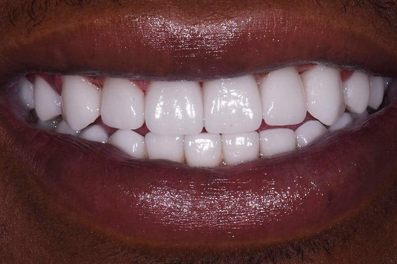 Patient Smile Before & After Gallery - Patient 861523 - Image 4