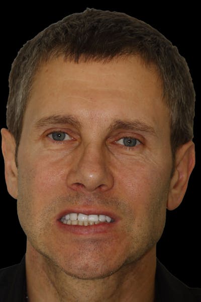 Patient Smile Before & After Gallery - Patient 820625 - Image 1
