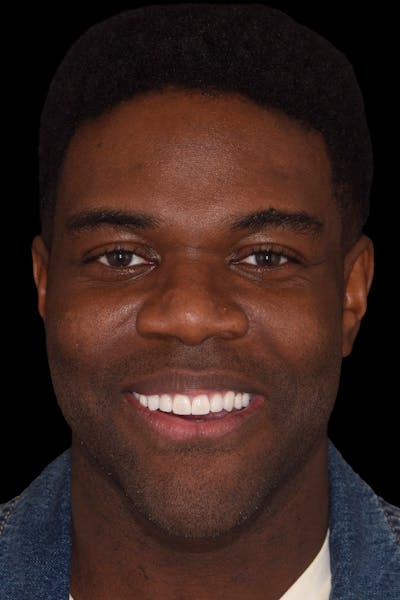 Patient Smile Before & After Gallery - Patient 129997 - Image 2