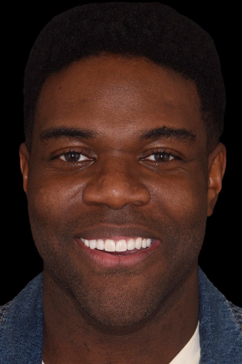 Patient Smile Before & After Gallery - Patient 129997 - Image 2