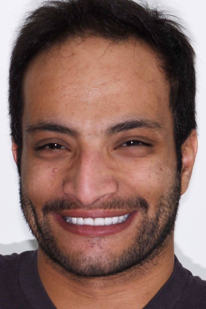 Patient Smile Before & After Gallery - Patient 241189 - Image 2