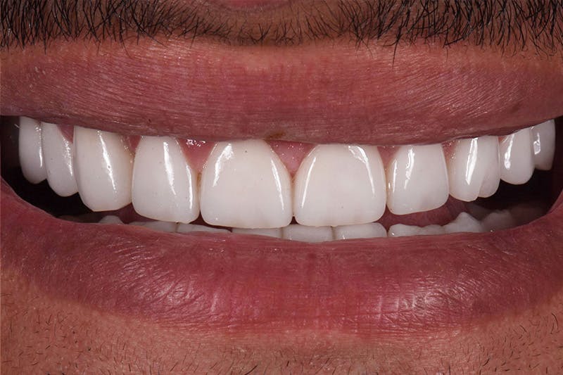 Patient Smile Before & After Gallery - Patient 241189 - Image 4