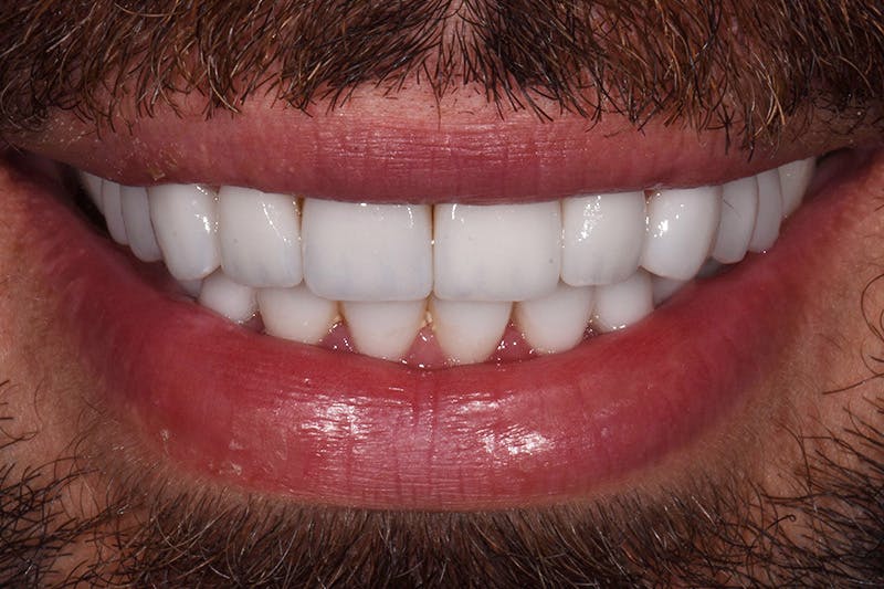 Patient Smile Before & After Gallery - Patient 579480 - Image 4