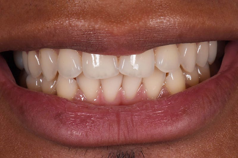 Patient Smile Before & After Gallery - Patient 687251 - Image 3