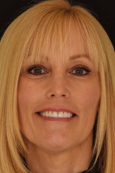 Patient Smile Before & After Gallery - Patient 361250 - Image 2