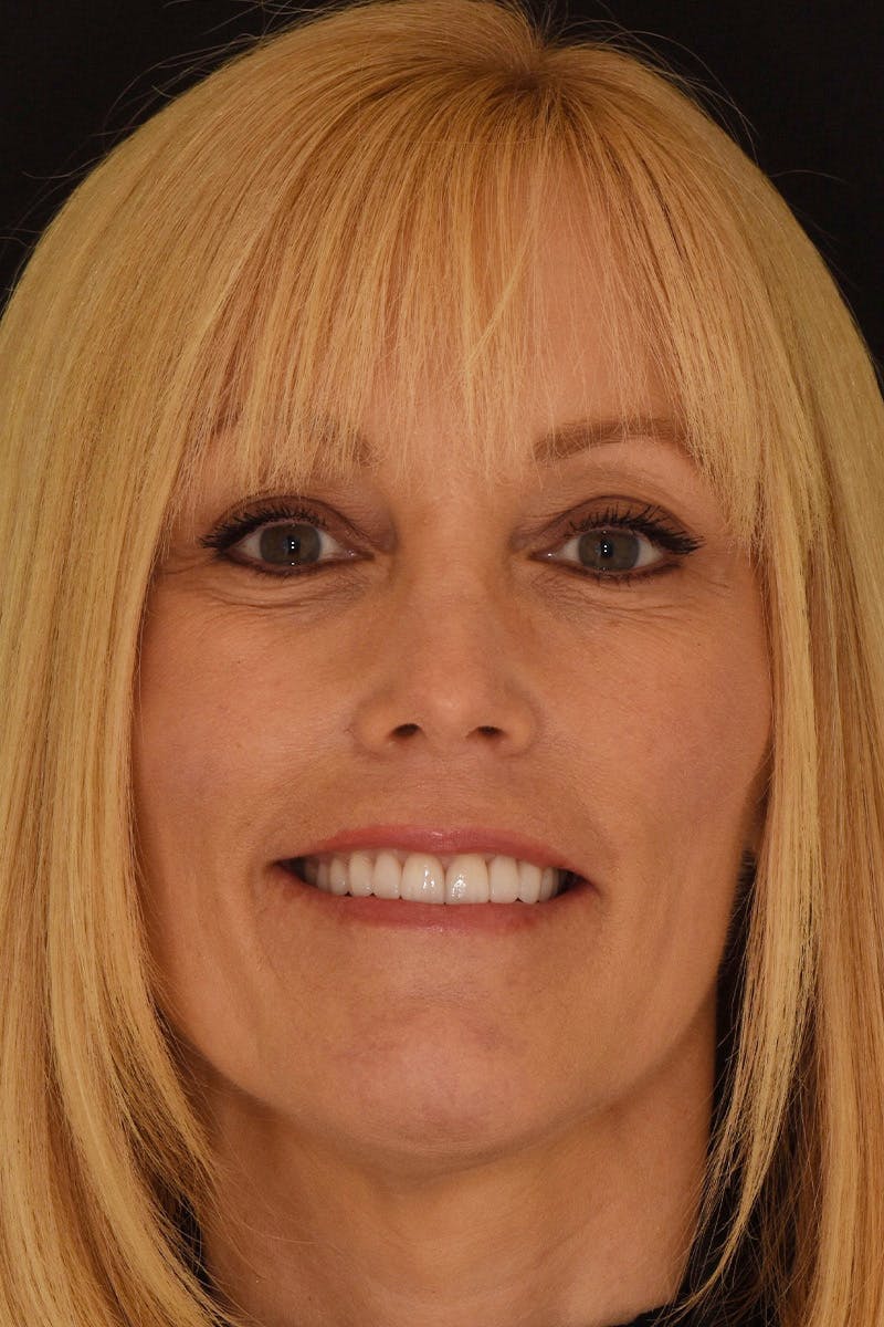 Patient Smile Before & After Gallery - Patient 361250 - Image 2
