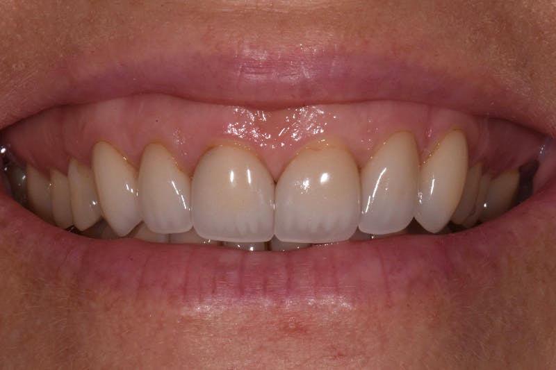 Patient Smile Before & After Gallery - Patient 361250 - Image 3