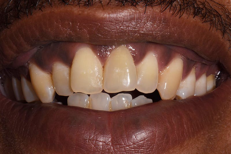 Patient Smile Before & After Gallery - Patient 428130 - Image 3