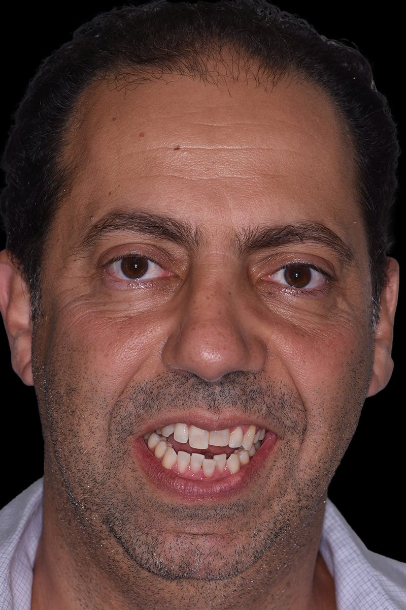 Patient Smile Before & After Gallery - Patient 167496 - Image 1