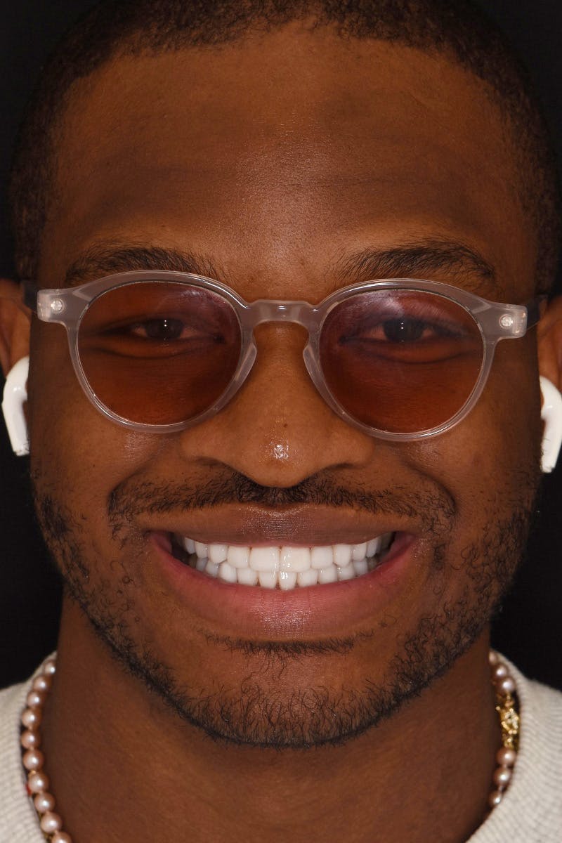 Patient Smile Before & After Gallery - Patient 306739 - Image 2