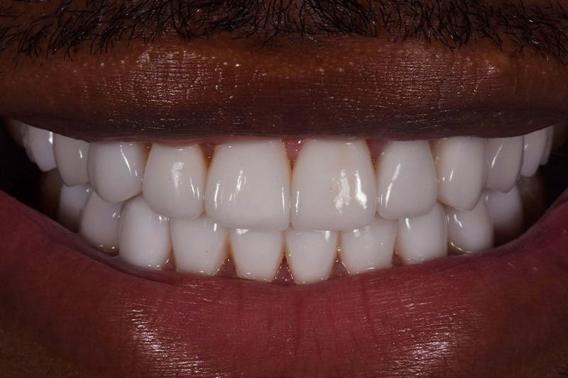 Patient Smile Before & After Gallery - Patient 306739 - Image 4