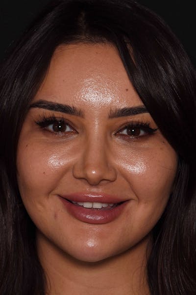 Patient Smile Before & After Gallery - Patient 117429 - Image 1