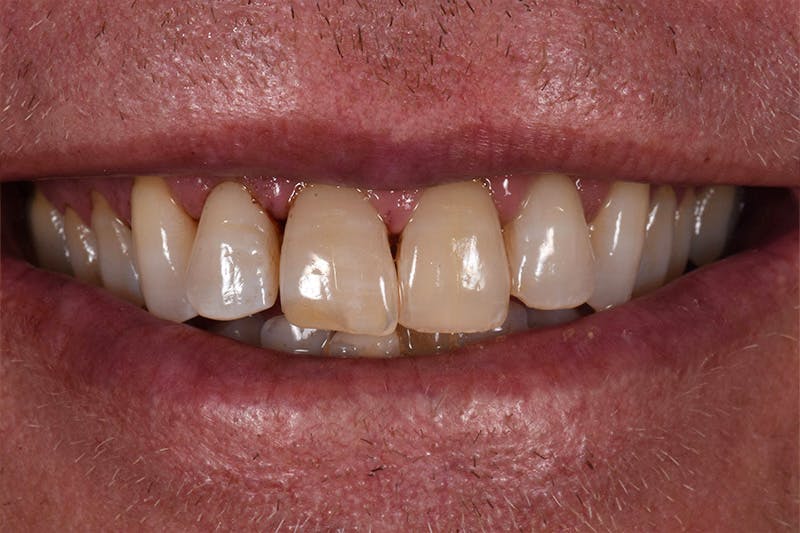 Patient Smile Before & After Gallery - Patient 165201 - Image 3
