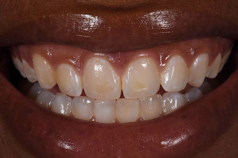Patient Smile Before & After Gallery - Patient 271095 - Image 3
