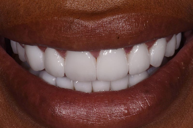 Patient Smile Before & After Gallery - Patient 271095 - Image 4