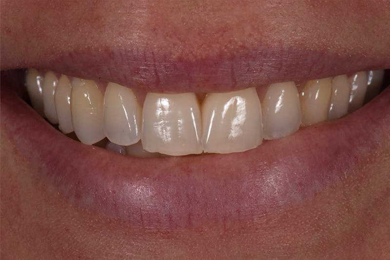 Patient Smile Before & After Gallery - Patient 249307 - Image 3