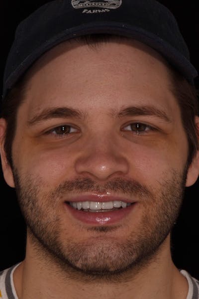 Patient Smile Before & After Gallery - Patient 154356 - Image 2