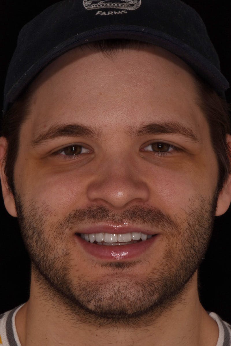 Patient Smile Before & After Gallery - Patient 154356 - Image 2