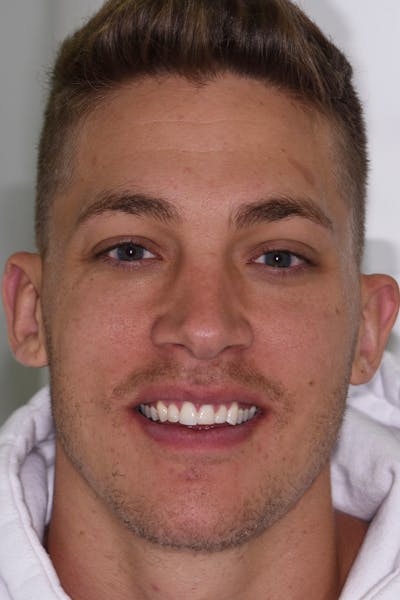 Patient Smile Before & After Gallery - Patient 404042 - Image 1