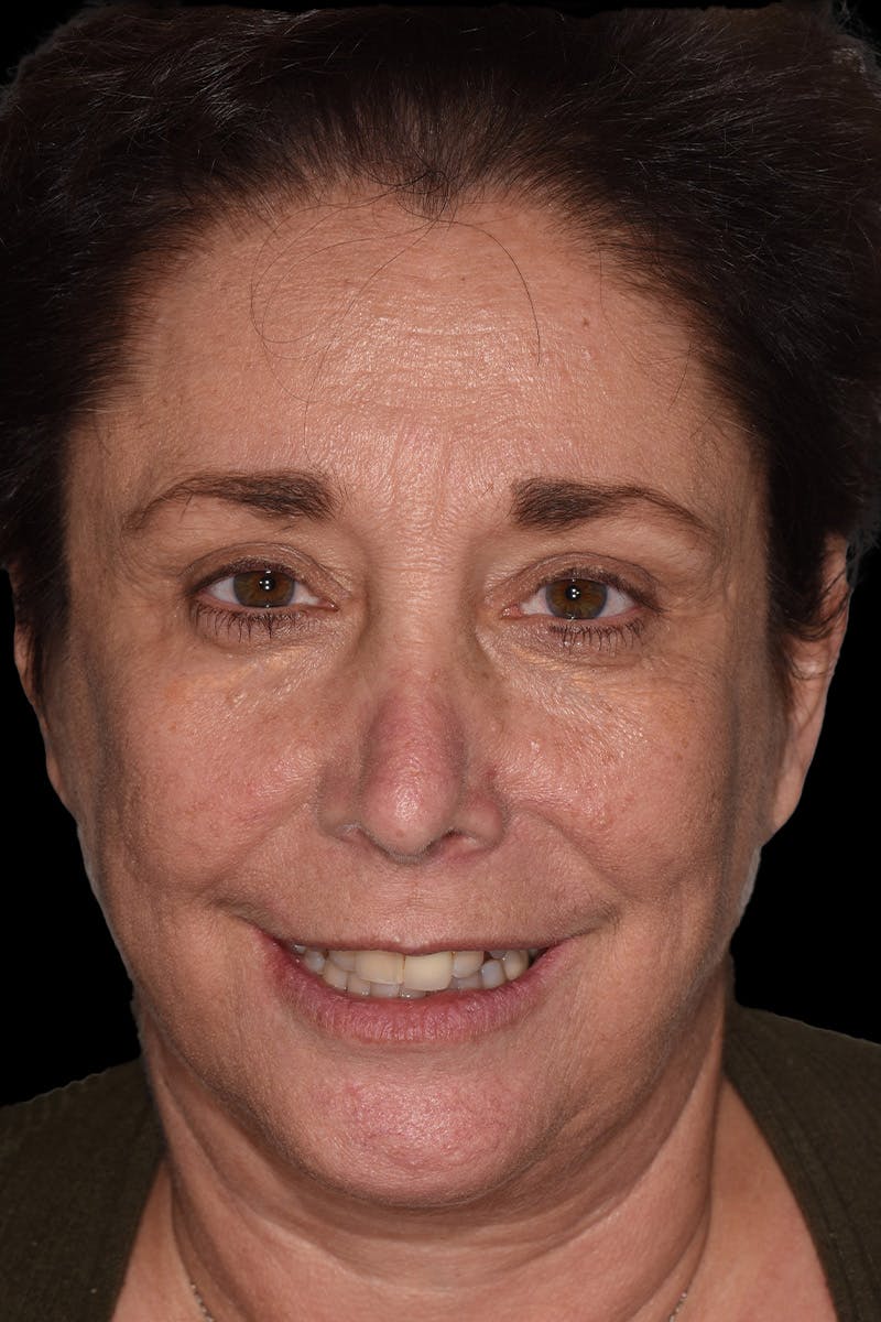 Patient Smile Before & After Gallery - Patient 282765 - Image 1