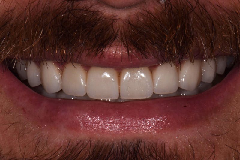 Patient Smile Before & After Gallery - Patient 375478 - Image 4