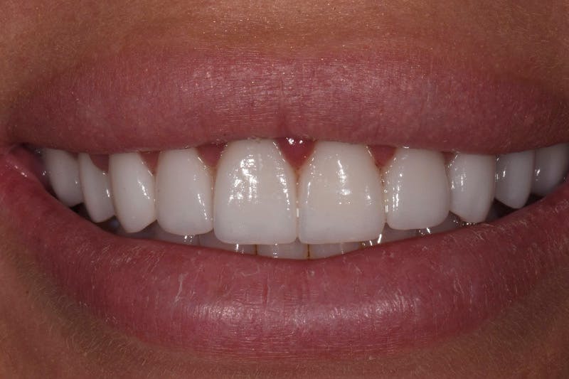 Patient Smile Before & After Gallery - Patient 136409 - Image 4