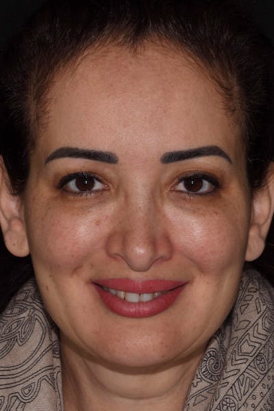 Patient Smile Before & After Gallery - Patient 350272 - Image 1