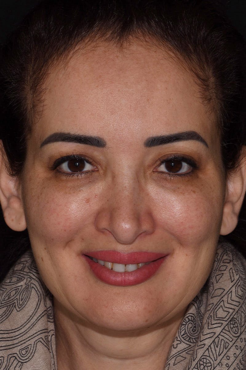 Patient Smile Before & After Gallery - Patient 350272 - Image 1