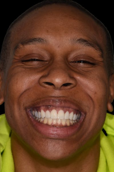 Patient Smile Before & After Gallery - Patient 269913 - Image 1