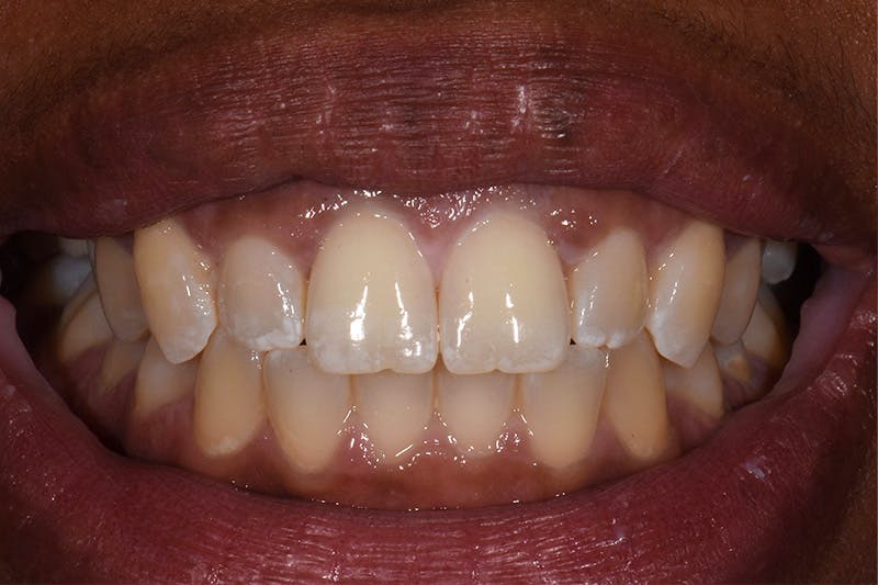 Patient Smile Before & After Gallery - Patient 269913 - Image 3