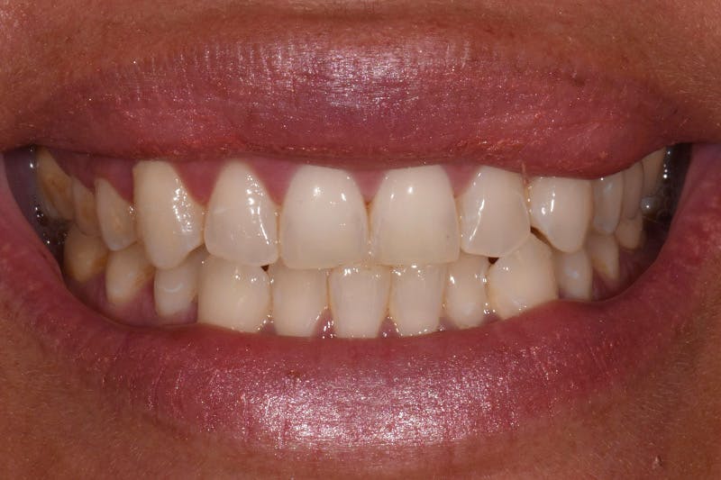 Patient Smile Before & After Gallery - Patient 167863 - Image 3