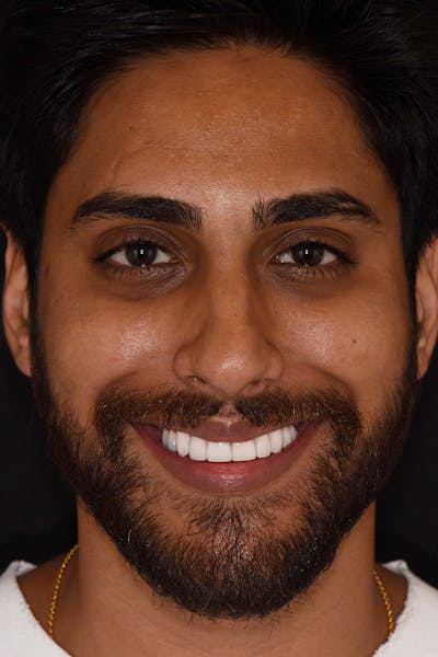 Patient Smile Before & After Gallery - Patient 738058 - Image 2