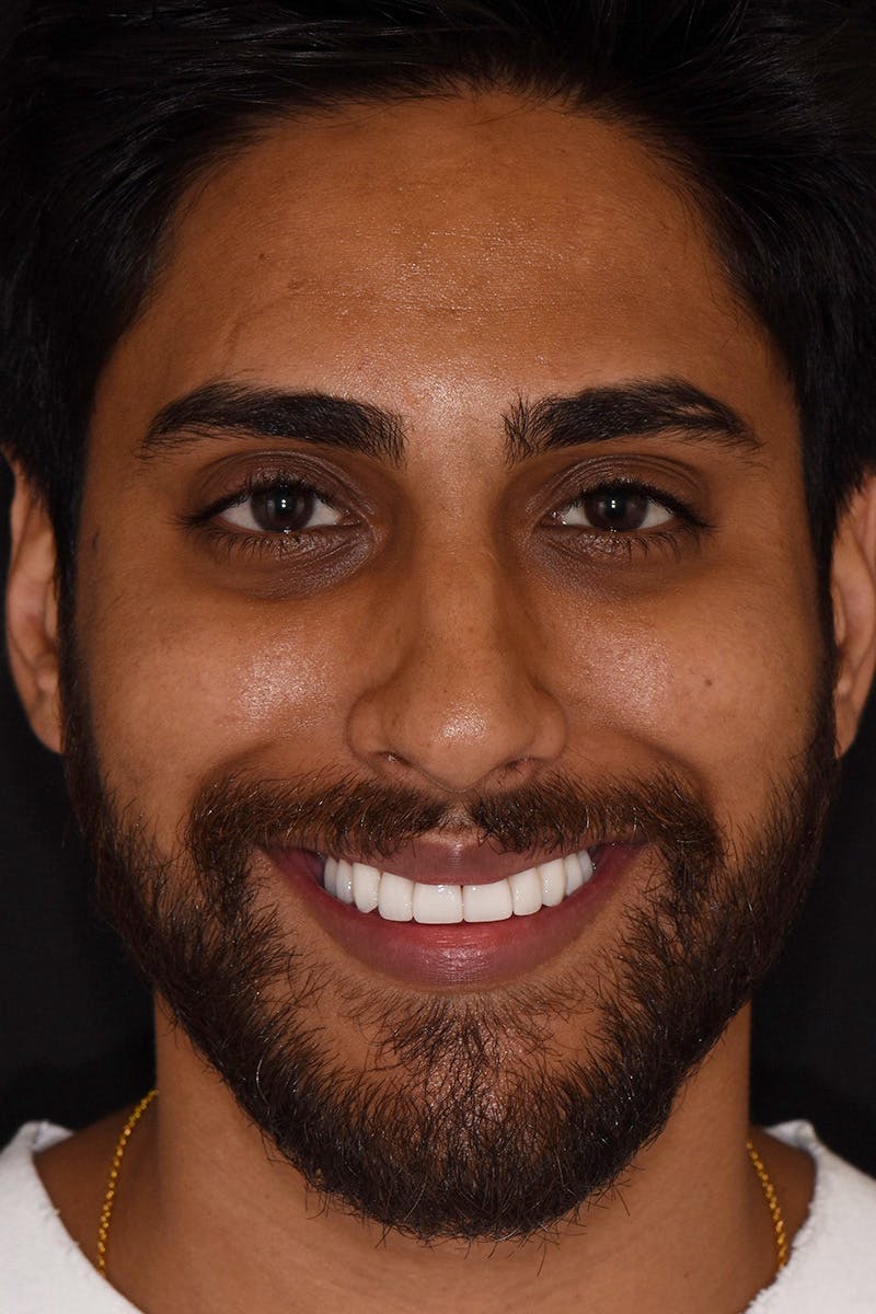 Patient Smile Before & After Gallery - Patient 738058 - Image 2