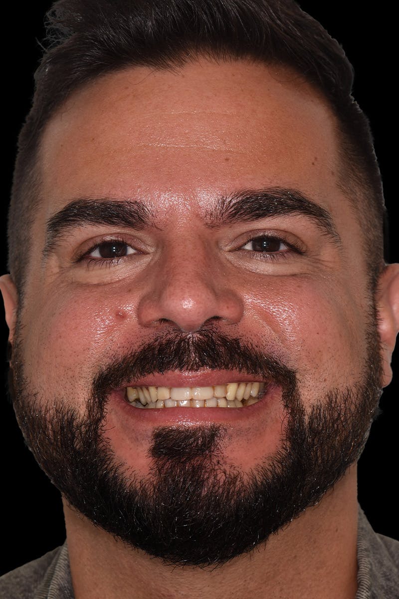 Patient Smile Before & After Gallery - Patient 206946 - Image 1