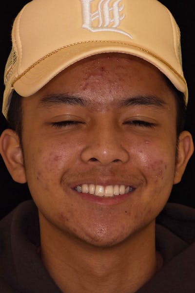 Patient Smile Before & After Gallery - Patient 242758 - Image 1