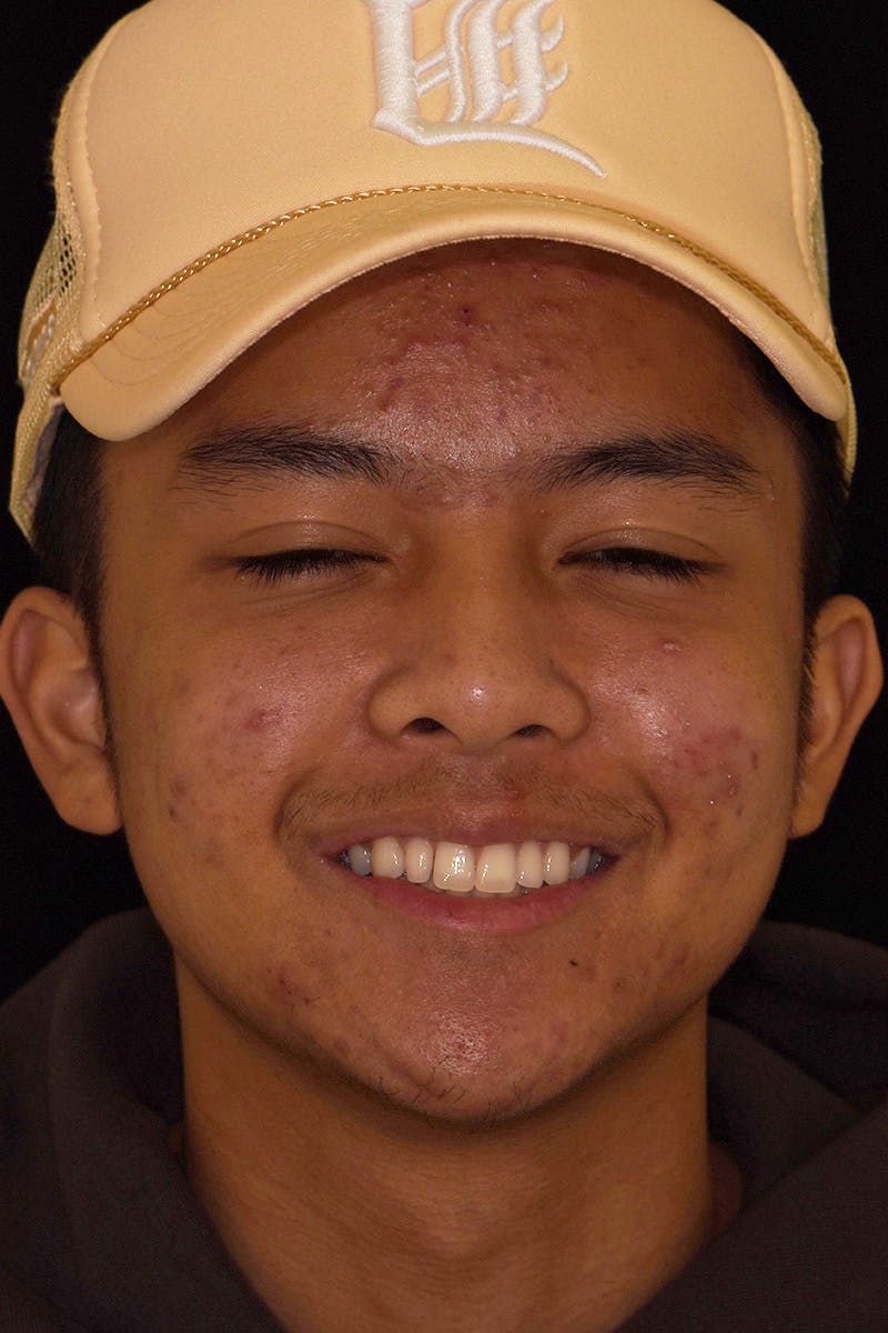 Patient Smile Before & After Gallery - Patient 242758 - Image 1