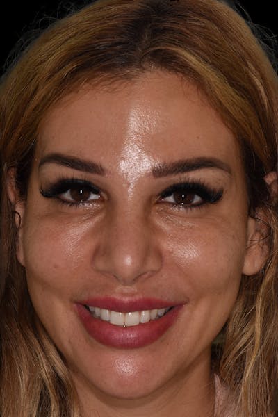 Patient Smile Before & After Gallery - Patient 175633 - Image 1