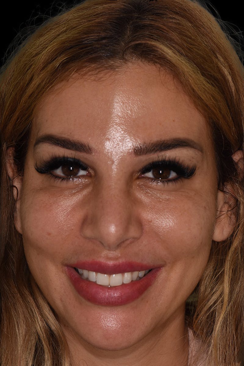 Patient Smile Before & After Gallery - Patient 175633 - Image 1