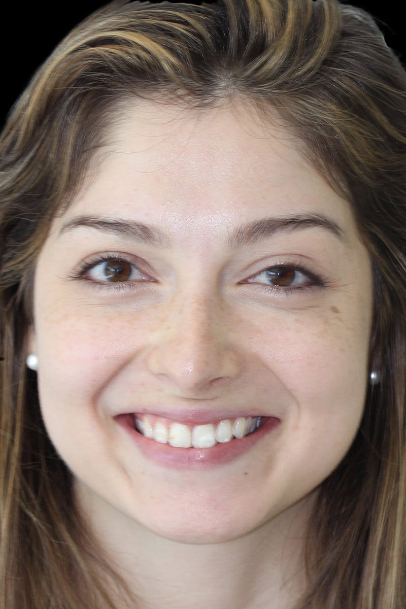 Patient Smile Before & After Gallery - Patient 227308 - Image 1