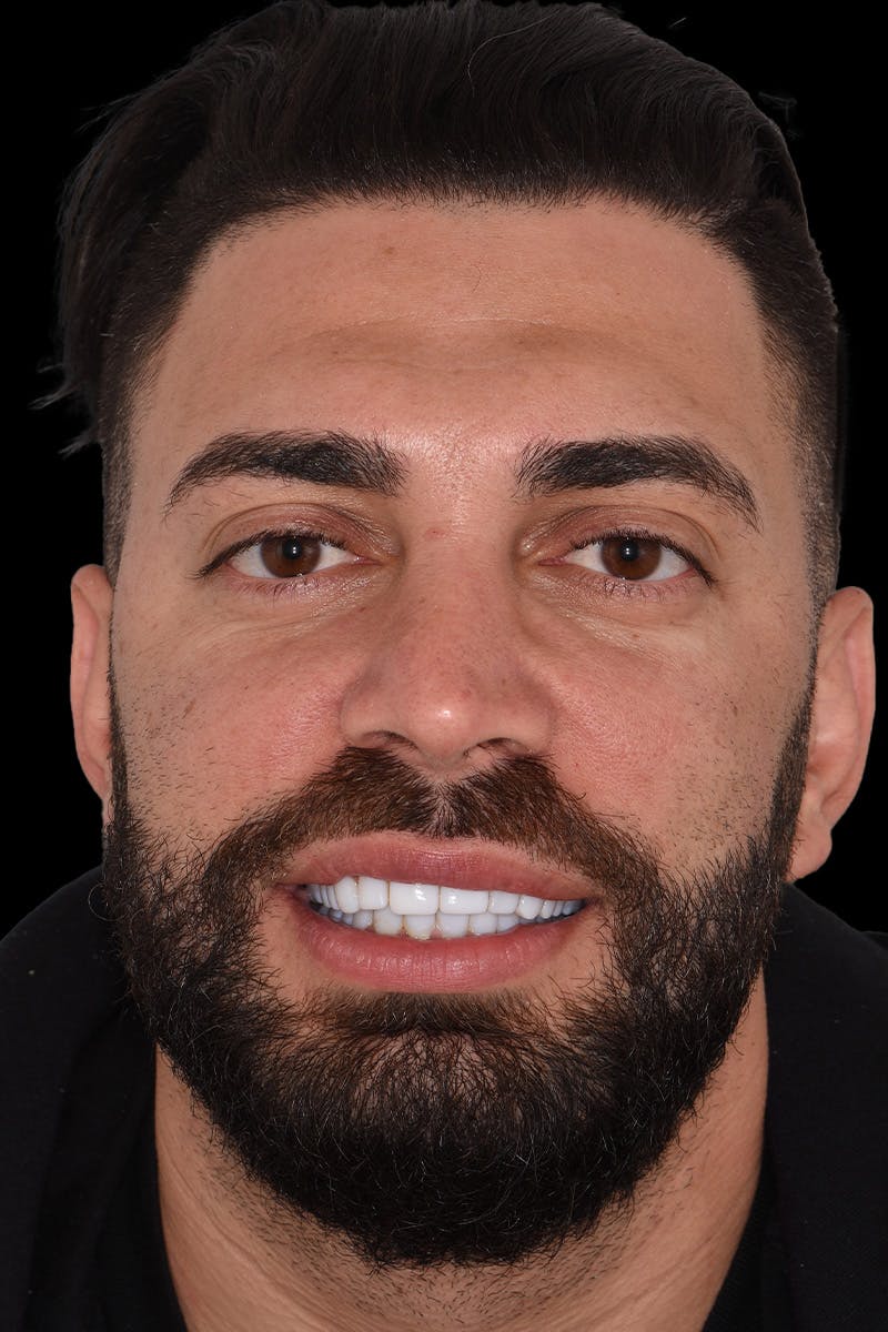 Patient Smile Before & After Gallery - Patient 579480 - Image 1
