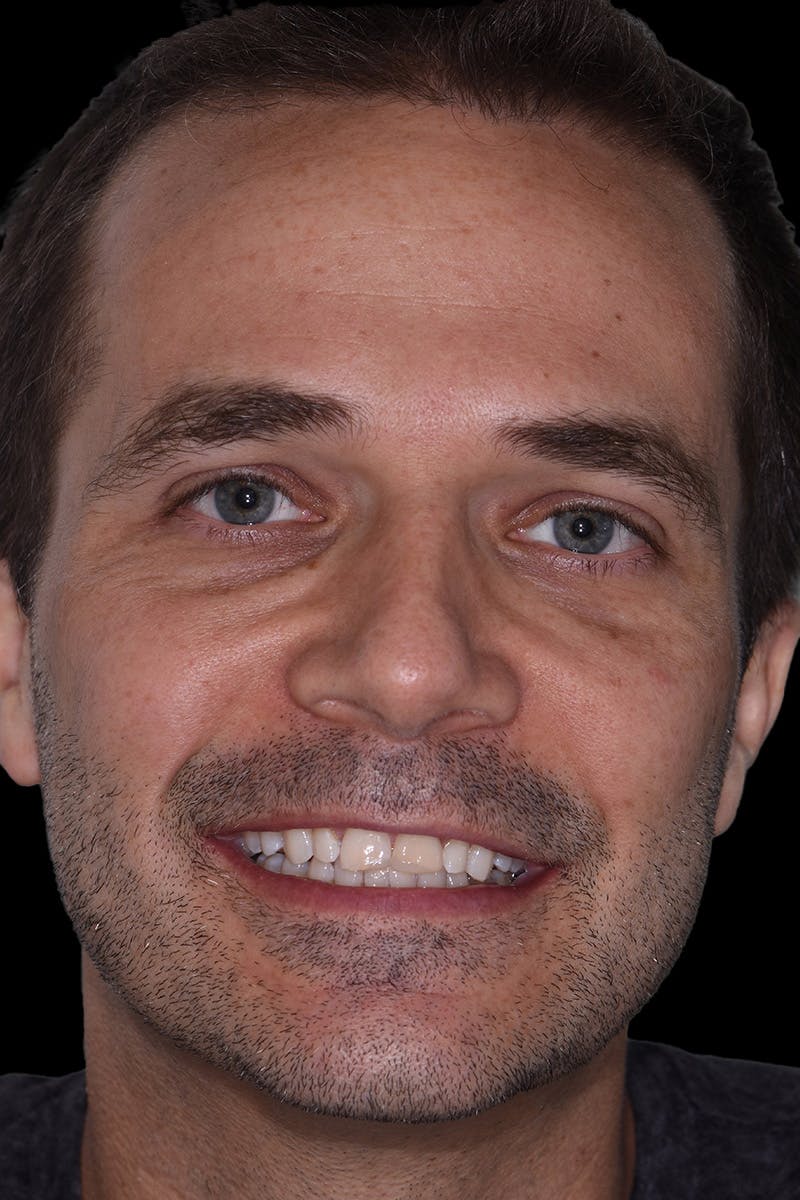 Patient Smile Before & After Gallery - Patient 347431 - Image 1