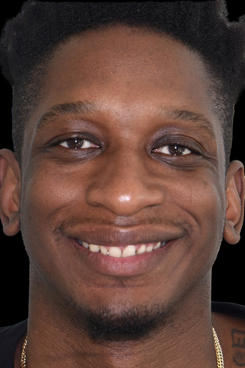 Patient Smile Before & After Gallery - Patient 912821 - Image 1